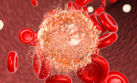 Leucemia